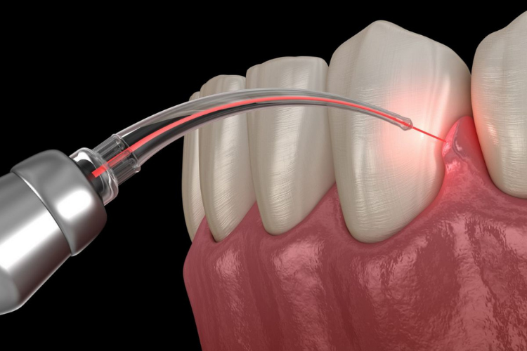 Laser Root Canal